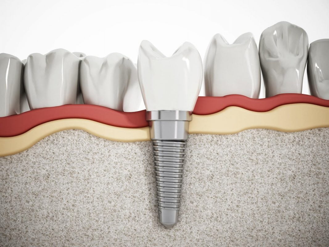 Dental Implants Turkey kusadasi