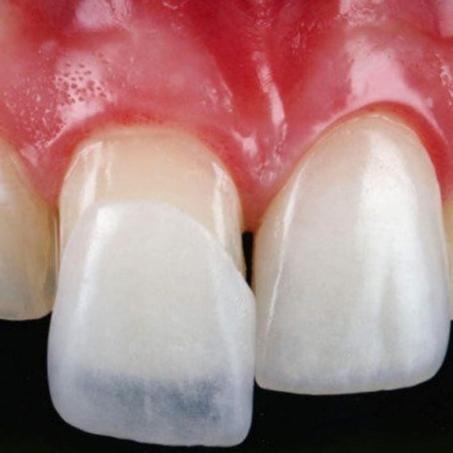 Laminate Teeth in Kusadasi Park Dental Clinic Kusadasi, Dentist