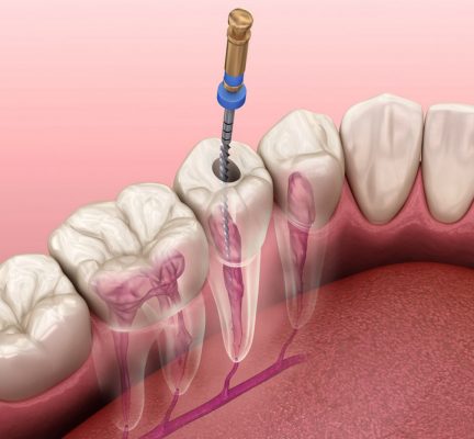 root canal treatment in kusadasi